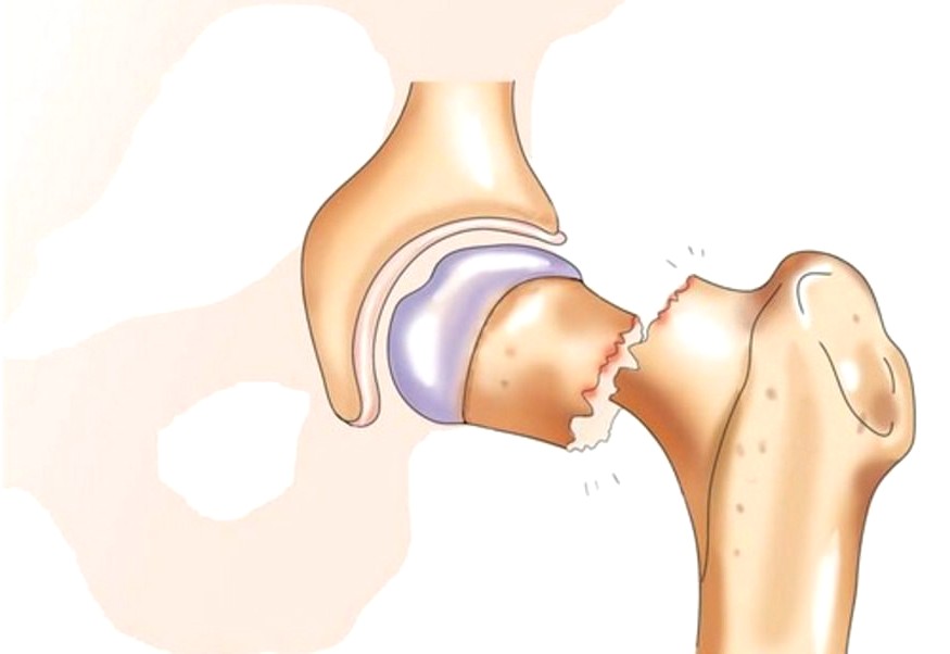 причины перелома шейки бедра