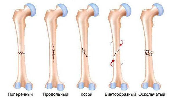 Перелом бедренной кости