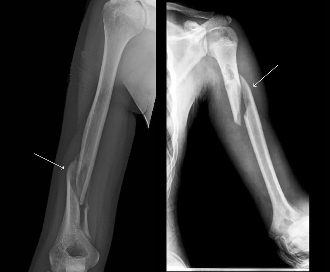 Перелом плечевой кости