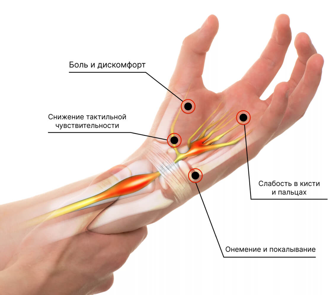 Симптомы синдрома запястного канала