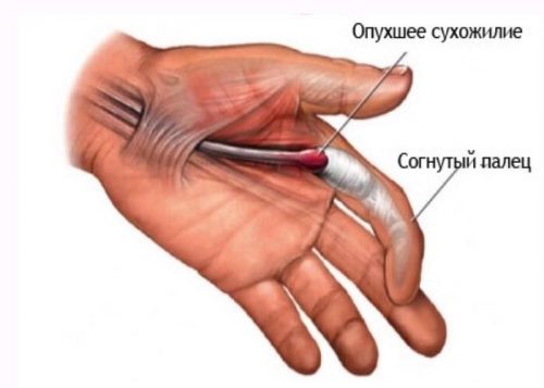 Согнутый-палец-при-болезни-Нотта.jpg