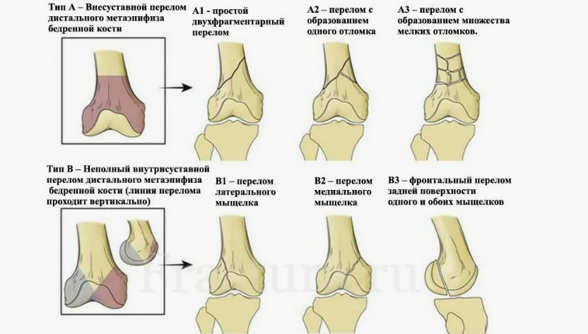 виды повреждений мыщелков.png