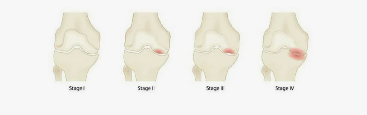 стадии асептического некроза коленного сустава.png